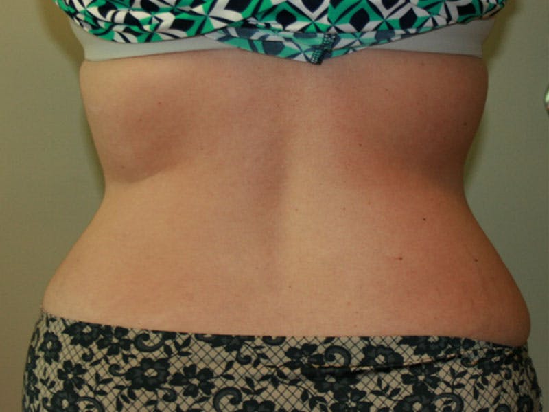 Tummy Tuck Before & After Gallery - Patient 87555321 - Image 4
