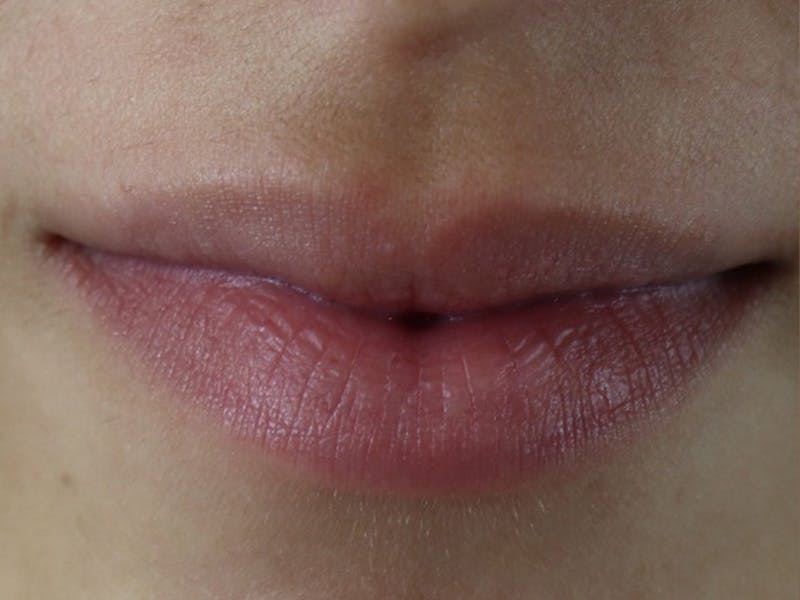 Lip Filler Before & After Gallery - Patient 87555322 - Image 3