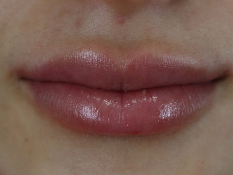 Lip Filler Before & After Gallery - Patient 87555322 - Image 4