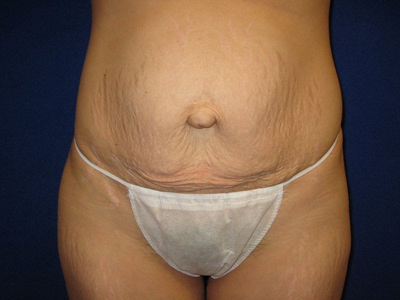 Tummy Tuck Before & After Gallery - Patient 87555324 - Image 1