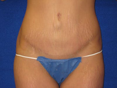 Tummy Tuck Before & After Gallery - Patient 87555324 - Image 2
