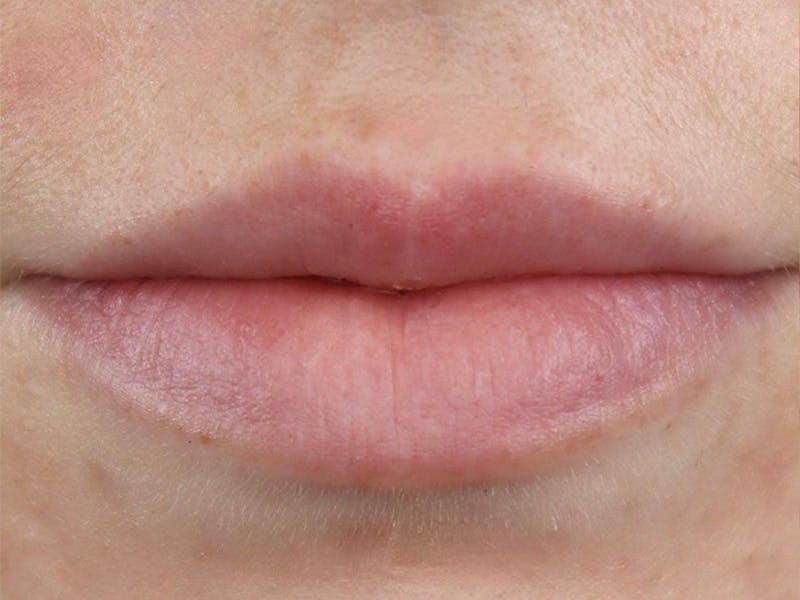 Lip Filler Before & After Gallery - Patient 87555326 - Image 1