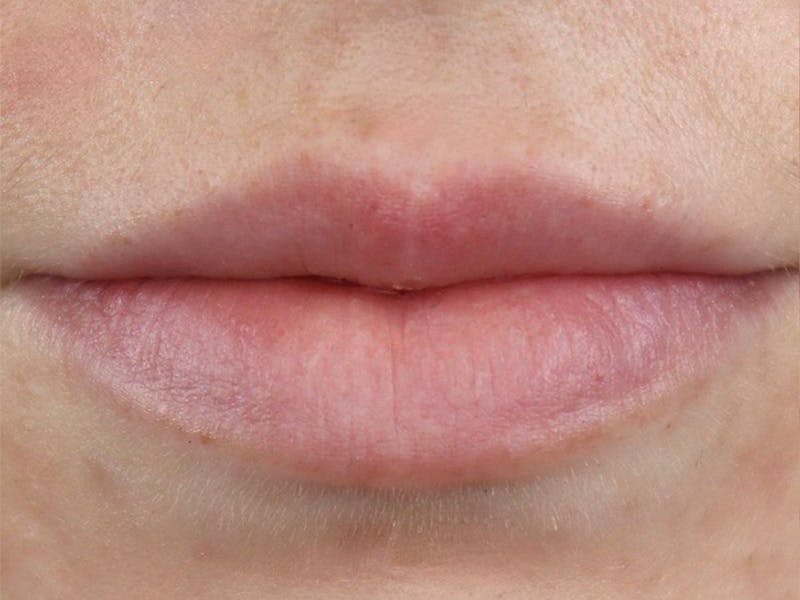 Lip Filler Before & After Gallery - Patient 87555326 - Image 1