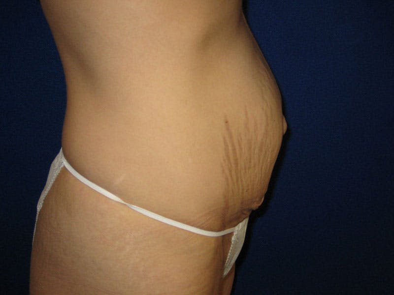 Tummy Tuck Before & After Gallery - Patient 87555324 - Image 3