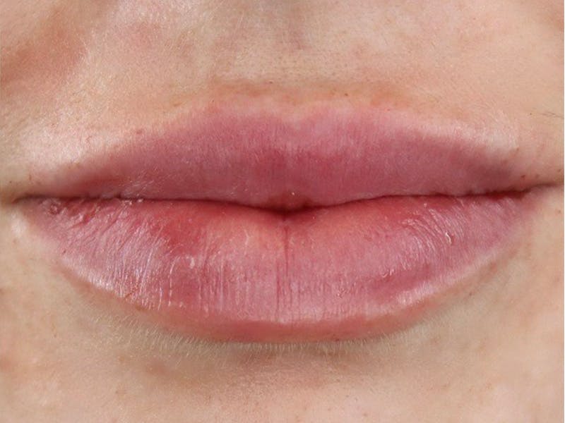 Lip Filler Before & After Gallery - Patient 87555326 - Image 2