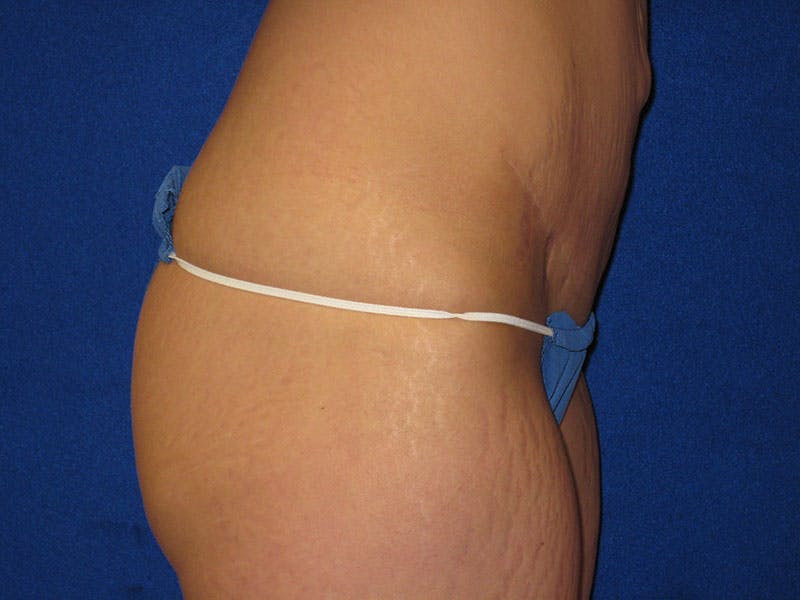 Tummy Tuck Before & After Gallery - Patient 87555324 - Image 4
