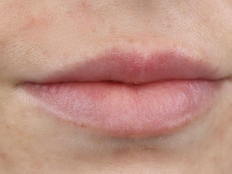 Lip Filler Before & After Gallery - Patient 87555326 - Image 3