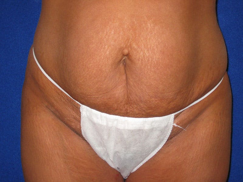 Tummy Tuck Before & After Gallery - Patient 87555328 - Image 1