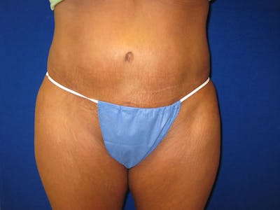 Tummy Tuck Before & After Gallery - Patient 87555328 - Image 2