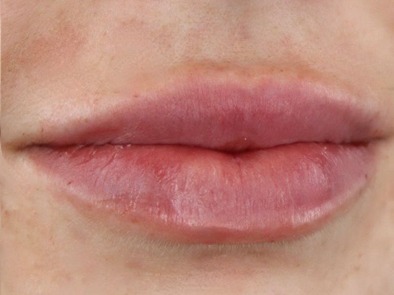 Lip Filler Before & After Gallery - Patient 87555326 - Image 4