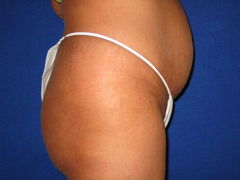 Tummy Tuck Before & After Gallery - Patient 87555328 - Image 3