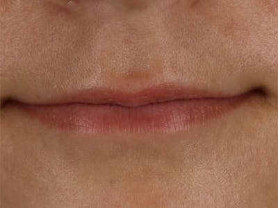 Lip Filler Before & After Gallery - Patient 87555332 - Image 1