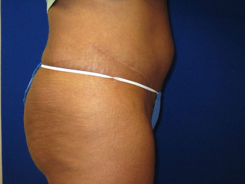 Tummy Tuck Before & After Gallery - Patient 87555328 - Image 4