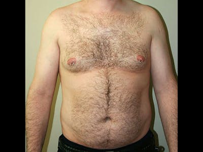 Liposuction Before & After Gallery - Patient 87555333 - Image 1