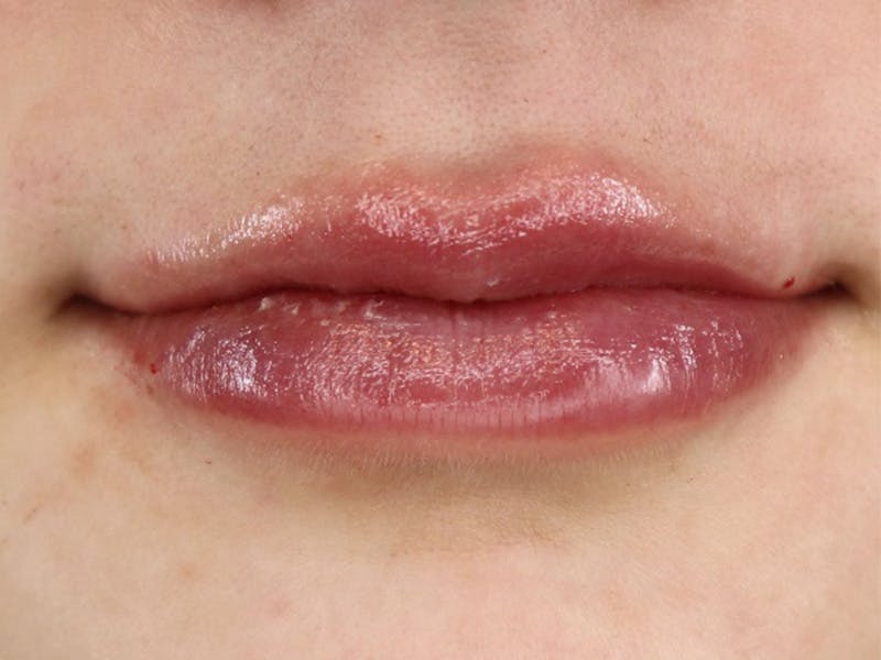 Lip Filler Before & After Gallery - Patient 87555332 - Image 2