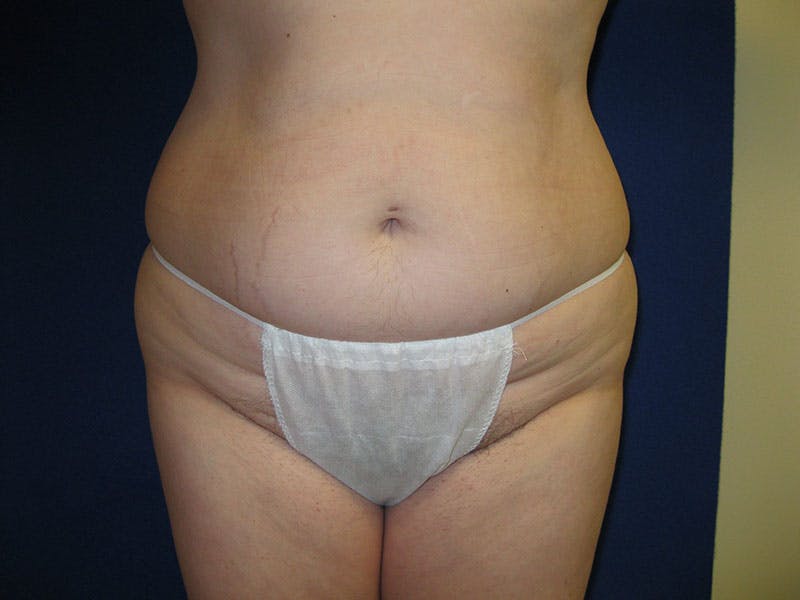Tummy Tuck Before & After Gallery - Patient 87555331 - Image 1