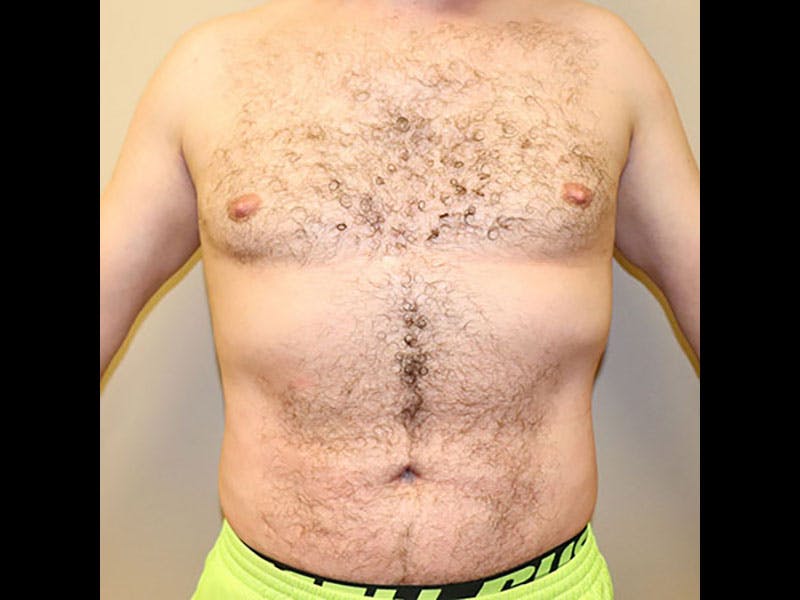 Liposuction Before & After Gallery - Patient 87555333 - Image 2