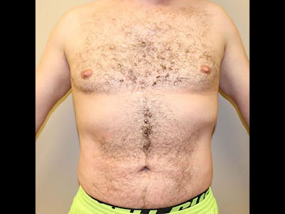 Liposuction Before & After Gallery - Patient 87555333 - Image 2