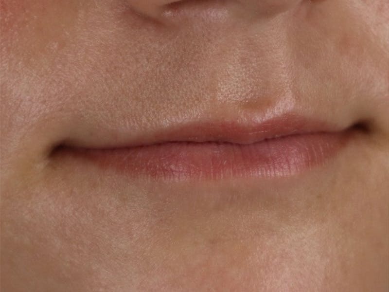 Lip Filler Before & After Gallery - Patient 87555332 - Image 3