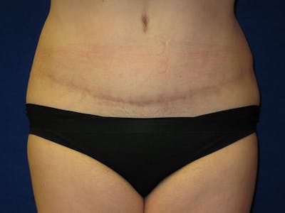 Tummy Tuck Before & After Gallery - Patient 87555331 - Image 2