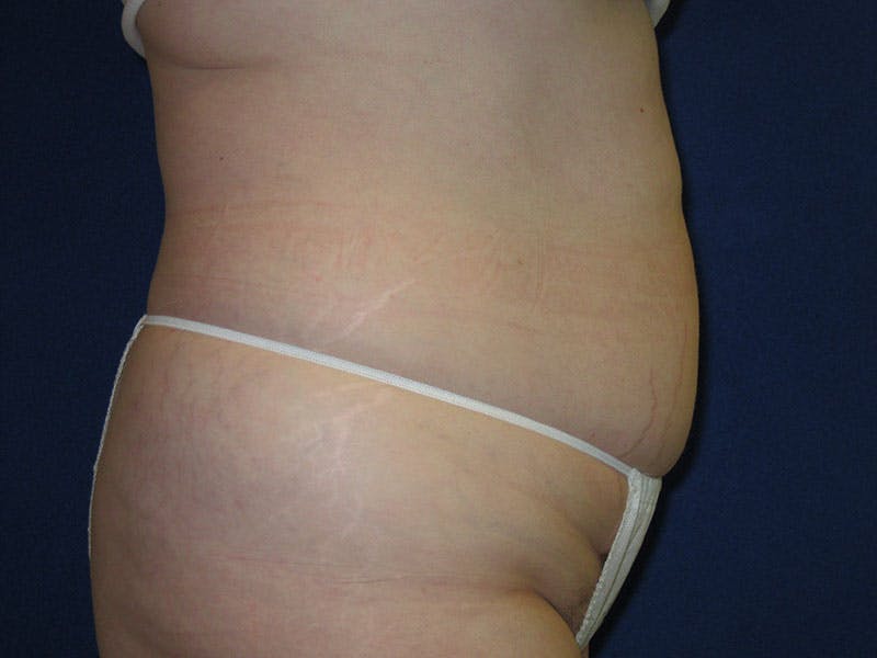 Tummy Tuck Before & After Gallery - Patient 87555331 - Image 3