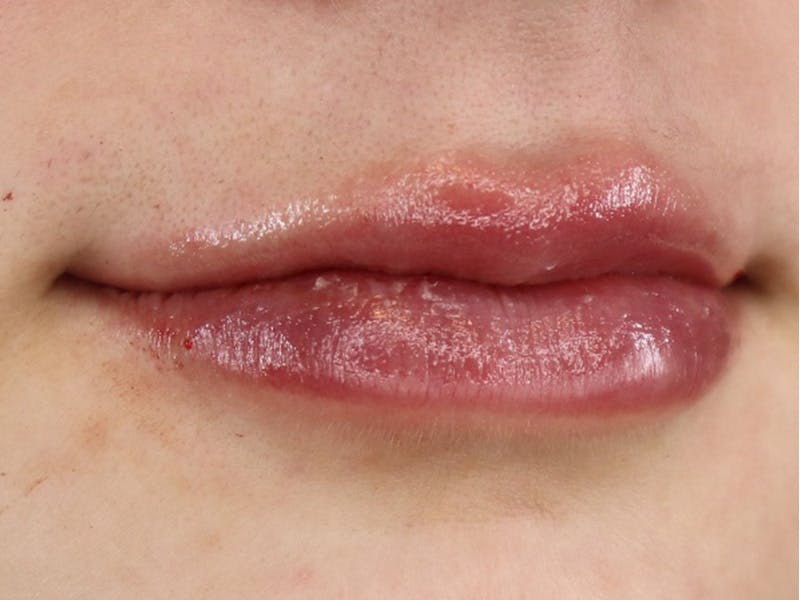 Lip Filler Before & After Gallery - Patient 87555332 - Image 4
