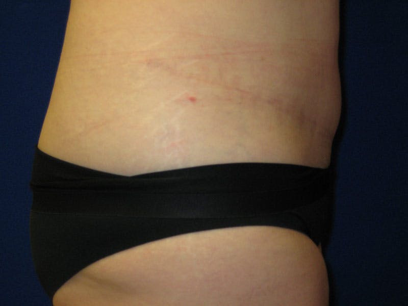 Tummy Tuck Before & After Gallery - Patient 87555331 - Image 4