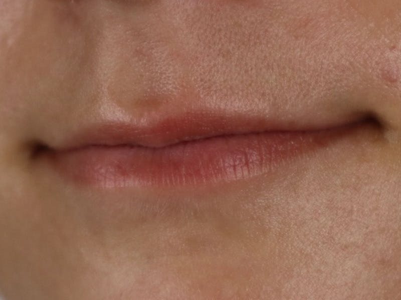 Lip Filler Before & After Gallery - Patient 87555332 - Image 5