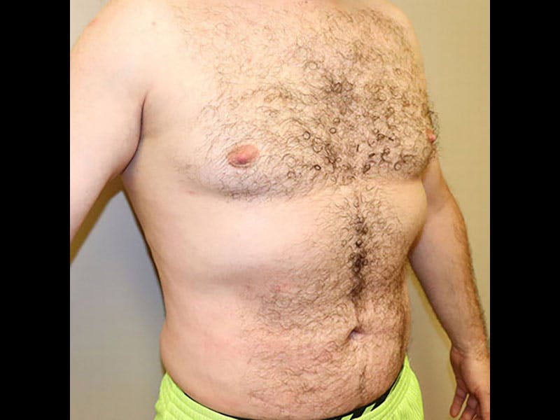 Liposuction Before & After Gallery - Patient 87555333 - Image 4