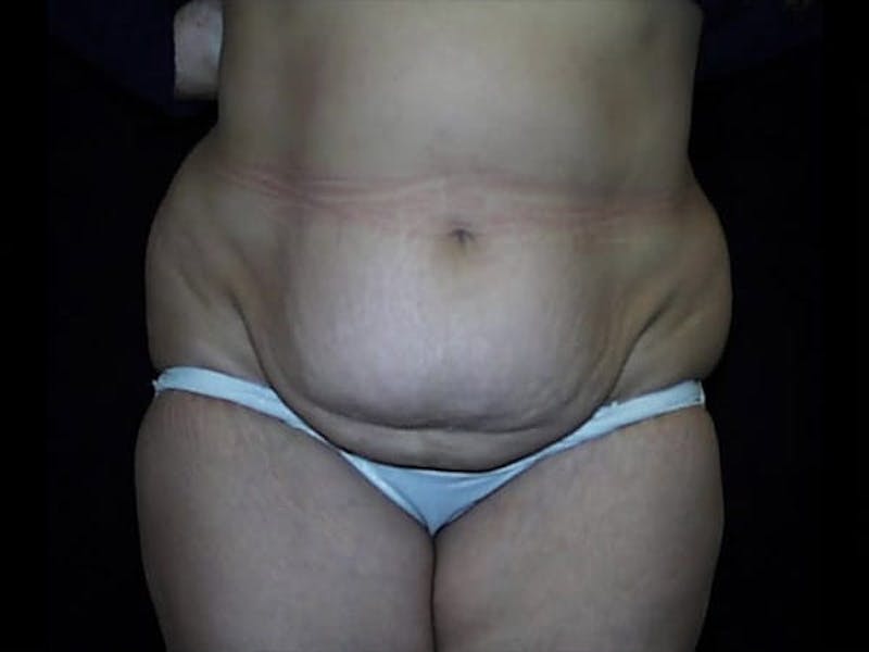 Tummy Tuck Before & After Gallery - Patient 87555345 - Image 1