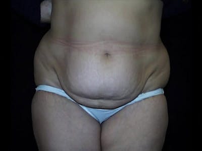 Tummy Tuck Before & After Gallery - Patient 87555345 - Image 1