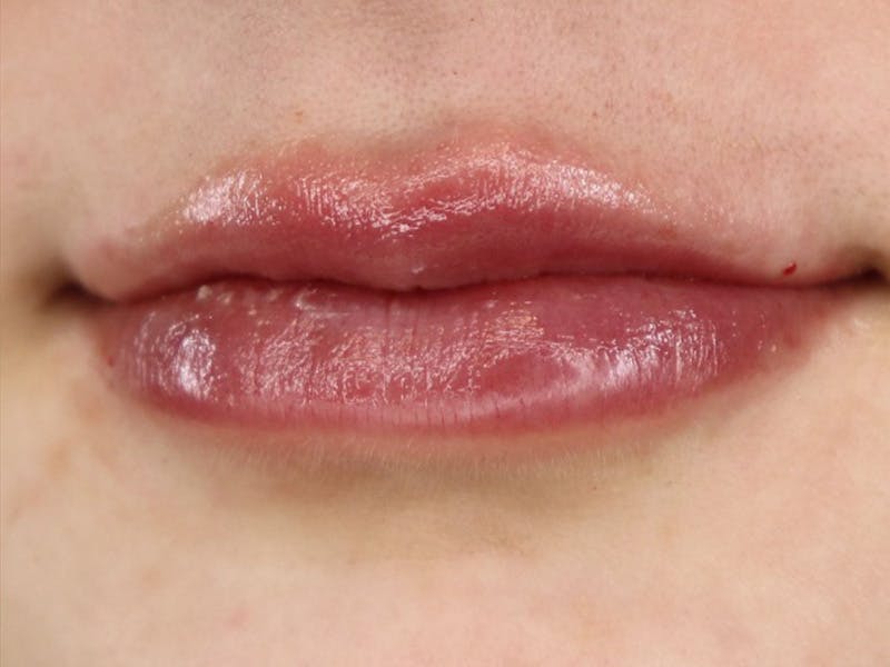 Lip Filler Before & After Gallery - Patient 87555332 - Image 6