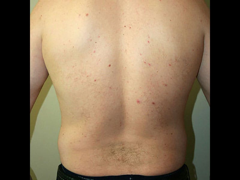 Liposuction Before & After Gallery - Patient 87555333 - Image 5