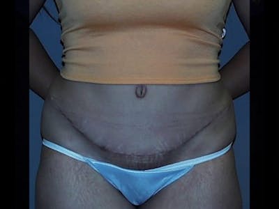 Tummy Tuck Before & After Gallery - Patient 87555345 - Image 2