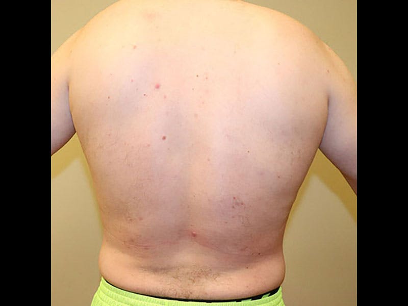 Liposuction Before & After Gallery - Patient 87555333 - Image 6