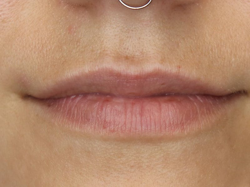 Lip Filler Before & After Gallery - Patient 87555349 - Image 1