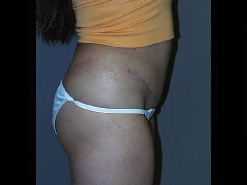 Tummy Tuck Before & After Gallery - Patient 87555345 - Image 4