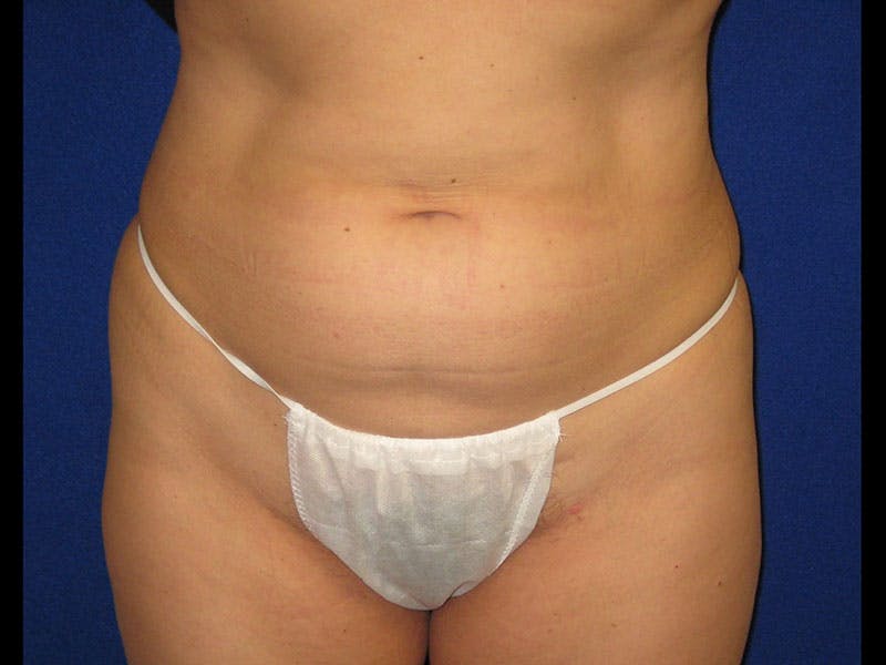 Liposuction Before & After Gallery - Patient 87555346 - Image 1
