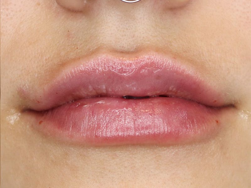 Lip Filler Before & After Gallery - Patient 87555349 - Image 2