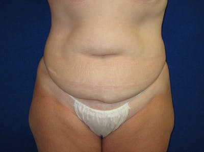 Tummy Tuck Before & After Gallery - Patient 87555347 - Image 1