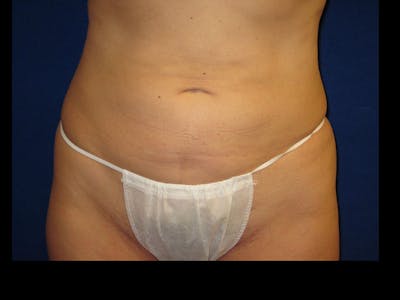 Liposuction Before & After Gallery - Patient 87555346 - Image 2