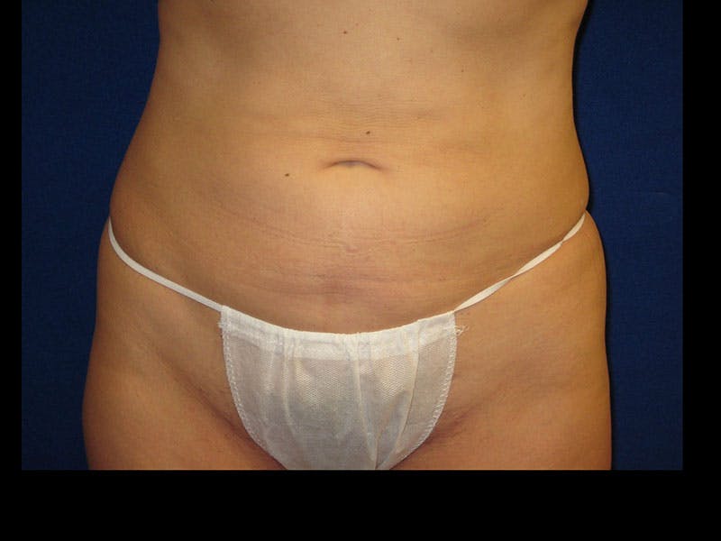 Liposuction Before & After Gallery - Patient 87555346 - Image 2