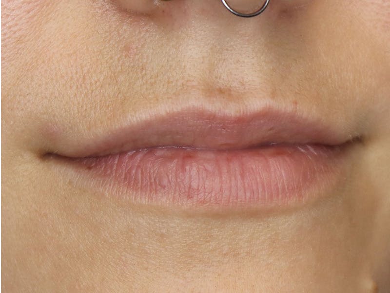 Lip Filler Before & After Gallery - Patient 87555349 - Image 3