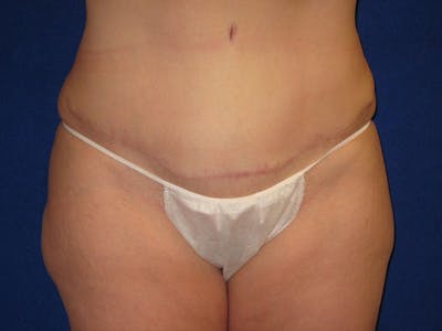 Tummy Tuck Before & After Gallery - Patient 87555347 - Image 2