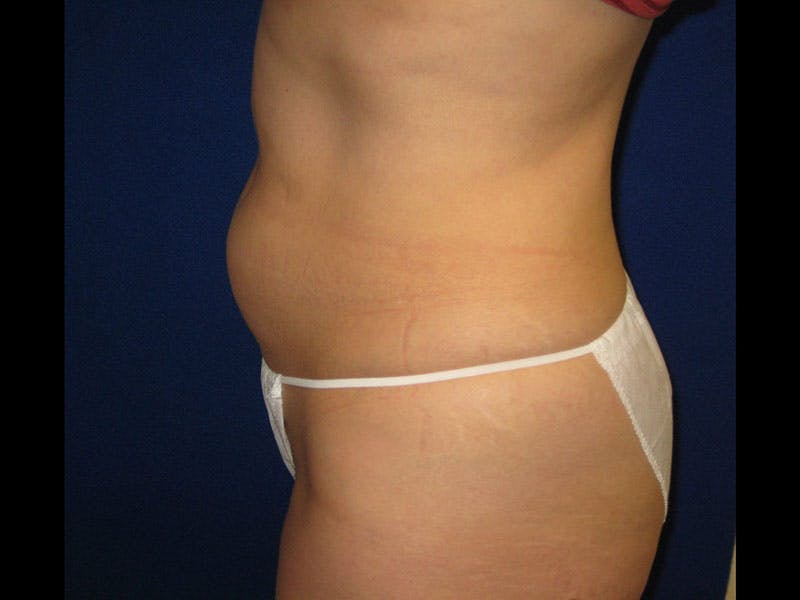 Liposuction Before & After Gallery - Patient 87555346 - Image 3