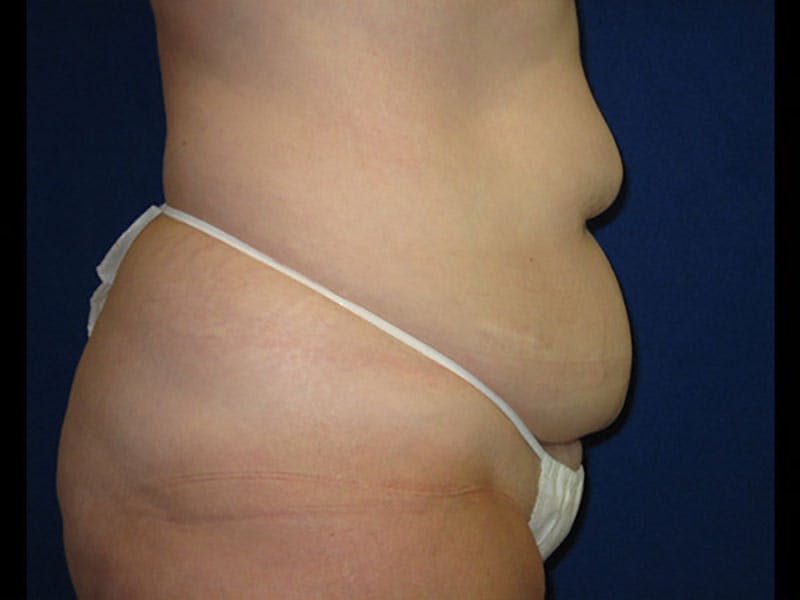Tummy Tuck Before & After Gallery - Patient 87555347 - Image 3