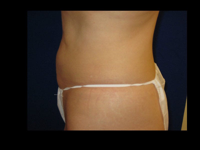 Liposuction Before & After Gallery - Patient 87555346 - Image 4