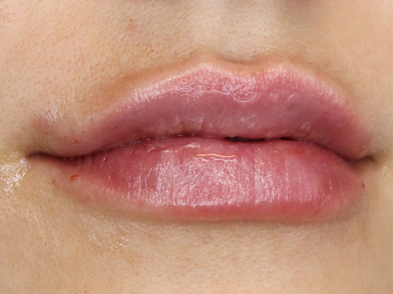 Lip Filler Before & After Gallery - Patient 87555349 - Image 4