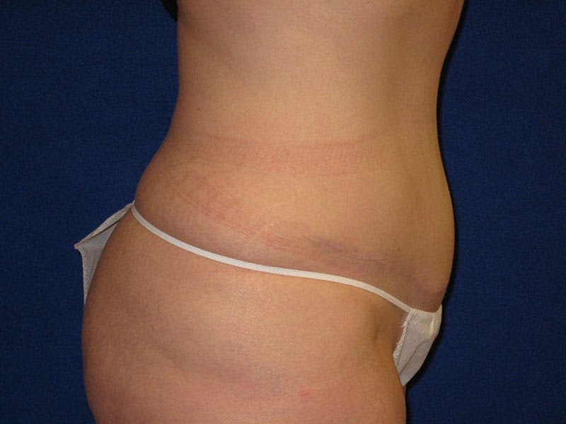 Tummy Tuck Before & After Gallery - Patient 87555347 - Image 4