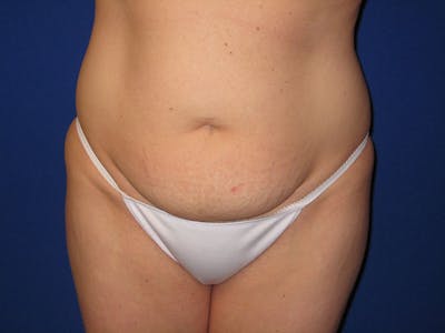 Tummy Tuck Before & After Gallery - Patient 87555354 - Image 1